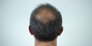 The condition affects both white and black men. Thicken Your Hair 11 Clever Hair Thickening Tips