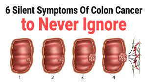 colon cancer symptoms and causes
