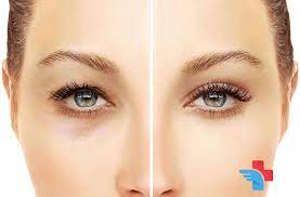 care after eyelid surgery gomed