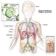 These cells are in the lymph nodes, spleen, thymus, bone marrow, and other parts of the body. What Is Childhood Hodgkin Lymphoma Cancer Disease Acco