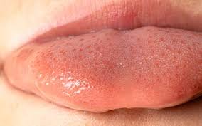 white patches on tongue causes and how