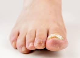 toenail thickening causes and how to