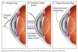 And sometimes it's better to wait longer. Lasik Eye Surgery Mayo Clinic