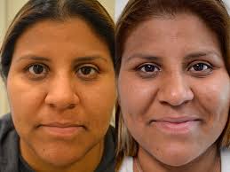 ptosis repair fresh face eye