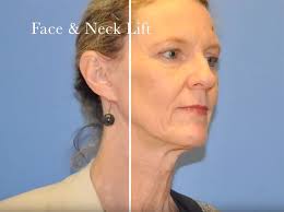neck lift surgery in sydney canberra