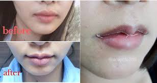 lip reduction surgery in asia crazy