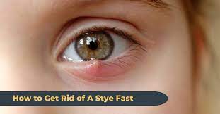 how to get rid of a stye fast