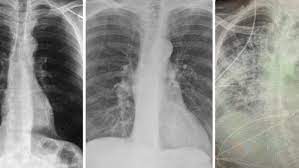 Coronavirus: voici la différence entre les poumons d'une personne en bonne  santé, d'un fumeur et d'un patient Covid-19 (photos)