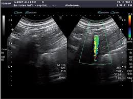 Value Of Color Doppler Ultrasound Kub And Urinalysis In