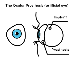 evisceration prosthetic eye surgery