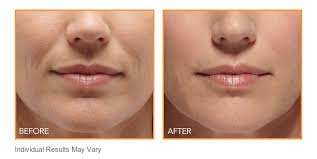 botox for mouth lines wrinkles nyc