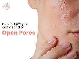 how to get rid of open pores cases