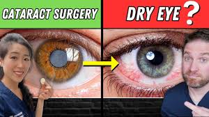 dry eyes after cataract surgery