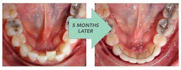 Examples of this would be how we can cause our teeth to become crooked over time like we discussed in the previous article or how braces function to shift teeth. Retainers For Life