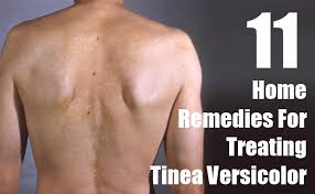 treating tinea versicolor