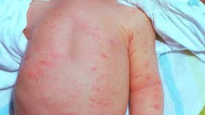 rash on child s chest types symptoms