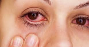 تحذير من جفاف العين: DED.. وباء عالمي يجتاح كل منزل، تعرف عليه سببه
وعلاجه!