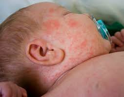 Image result for what is milk rash