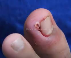 nail avulsion treatment in delhi nail