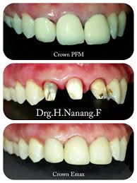 Replacement Old Crown Pfm With Crown Emax Dentistry Crown