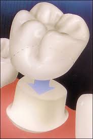 Resultado de imagen de funda dental
