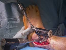 ankle arthrodesis fusion trans