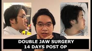 jaw surgery post op before and after