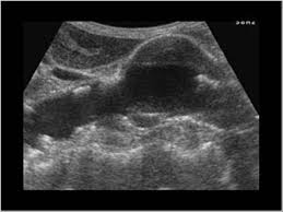 Abnormal liver function  but an urgent ultrasound scan of the patient s  liver was normal   YouTube