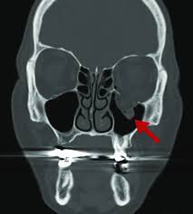 computed tomography image coronal view