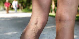 are spider veins anything to worry