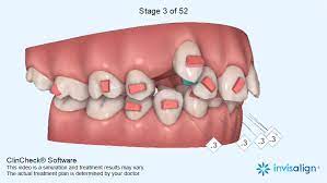 It may take up to 5 to 6 months for this process. When Why You Need Tooth Extraction For Orthodontic Treatment