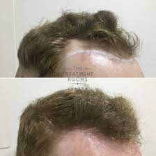 receding hairline treatment