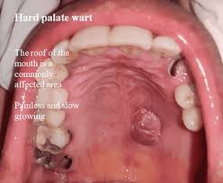 and common warts pictures on