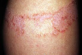 contact dermais symptoms rash and