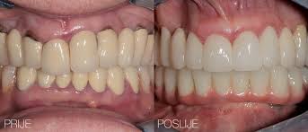Keramička krunica ili zubna krunica može biti metal keramička krunica, cirkon keramička krunica ili bezmetalna krunica. Keramicke Krunice Poliklinika Bagatin