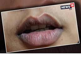 get rid of chapped and dark lips news18