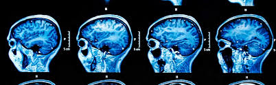 disease from a single brain scan