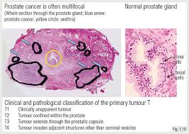 However, as with other types of cancer,. Tumours Of The Prostate Oncologypro