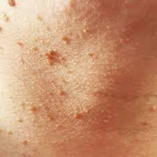 Milia is most common in newborns and may be mistaken for baby acne. 13 Face Bumps You Get Under Your Skin And How To Get Rid Of Them