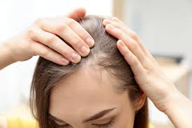 how to stop alopecia areata from