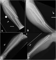 intramedullary nail fixation of tibial