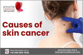 causes of skin cancer dermcos s