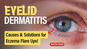 recognizing and treating eyelid dermais