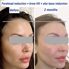 forehead reduction surgery harley clinic