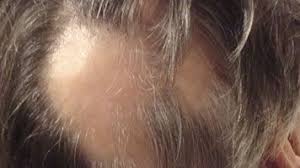 alopecia areata overview causes