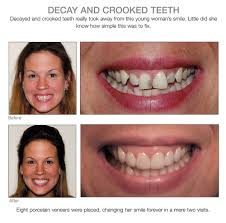 Instead of pulling the teeth into alignment, the approach is to create room for the teeth so that they can straighten naturally. Crooked Teeth Gone Carillas Dentales Estetica Dental Protesis Dental Fija
