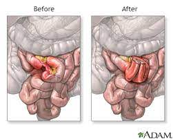 intestinal obstruction repair
