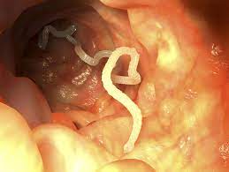 tapeworm symptoms causes diagnosis