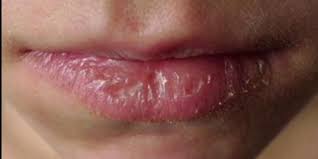 how to prevent and treat dry chapped lips