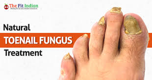 9 natural ways to treat toenail fungus